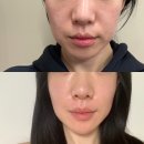 피부과 튠페이스 주기 부작용 타임락튠 2회차 후기