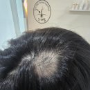 아지케어 | 인천 송도 두피 스케일링 두피밥 원형탈모 원인 진단과 유기농 두피팩 관리 받은 후기