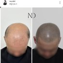 배곧초록유치원 | 시흥 배곧 정수리 두피 탈모 커버 가르마 채움 타투 헤어샵 나도트 + 커트 1회 서비스