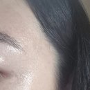 서면한의원 | 부산 서면 화접몽한의원 편평사마귀 내돈내산 제거 후기
