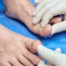 셀러블153강남의원 | 내성발톱+무좀, 강남발톱교정 셀러블153강남의원 솔직후기