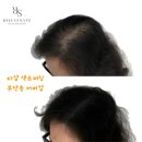 현헤어라인 이미지