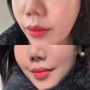 셀릭 | 청담피부과 힐로웨이브 30대 팔자주름 볼륨 효과 리쥬셀릭 재생크림 리얼후기