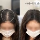 마음에점을찍다두피SMP 이미지