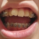 연세다정치과의원 | 메탈 치아 교정 스크류 통증 정도 -청량리역 교정치과 연세다정한치과 후기 (3번째 방문)