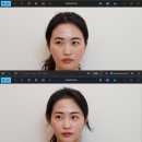 얼굴형관리 광대축소관리 윤곽관리 잘하는 곳 추천 강남 르수플 솔직후기