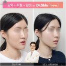 윤곽성형외과의원 | 윤곽성형외과 퀵광대축소술 후기 붓기 부작용 비용