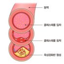 (동맥경화증) 초기증상과 자가진단,예방,자연치료 이미지