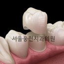 서울웅천치과 네이버블로그
