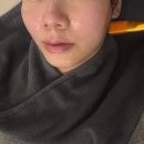 지성한방병원 | 강남 피부과 줄기세포 스킨부스터 피부주사_맞은 효과 및 솔직 후기