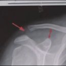 어깨질환 - 봉우리빗장관절 손상(Acromioclavicular Joint Pathology) 이미지