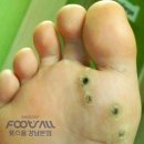 개발바닥 | 티눈으로 오해하기 쉬운 발바닥 사마귀 초등학교 어린이 관리후기