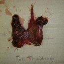 Bilateral Total Thyroidectomy 와 함께 Central Lymph node Dissection 이미지