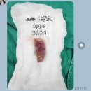 청병원 | 첫 수술이 된 맹장수술_청병원 입원 후기