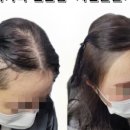 시선을즐기다탈모두피커버헤어라인전문부산점 이미지