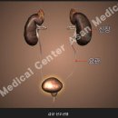 급성 방광염 이미지