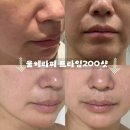 멍스타일 | 강남구청역피부과 솔린의원 울쎄라피프라임 멍 붓기 전후비교 후기