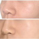 메디오름가정의학과의원 | 청담동피부과 기미 잡티제거 크롬레이저 스킨메디피부과 후기