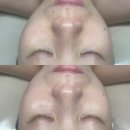 위례피부관리 베이비페이스케어 솔찍후기 디유에스테딕