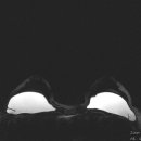 breast cohesive gel implant 이미지
