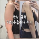 멍스타일 | 분당 팔뚝지방추출주사 전후 차이 후기 (멍 붓기 통증)