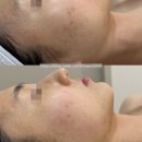 필오피스텔 | 창원 피부관리 잘하는 곳 찐추천 상남동 282에스케틱 여드름 트로이필 솔직후기