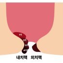 메딕약국 | 치질연고 추천 받고 약국 치질약 사용해본 후기