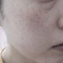 대구 신세계가정의학과의원 주근깨, 기미, 잡티 레이저 후기(내 돈 내산 1일차)