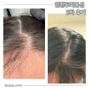 그레이헤어 - 유성구 온천북로59번길 34 | 인천두피문신 그레이시티 인천직영점 2차 후기, 오른쪽 헤어라인까지 더 채워진 날