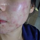 스테이영피부과의원 | 피부 트러블 정복기 _ 1편 (스테이영 피부과)