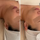 관골 | 구미피부관리 아로뮤에스테틱 무통증 윤곽관리 후기
