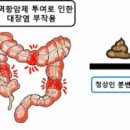 혈변 원인 5가지 및 과 대변 볼때 피 방법 : 치질 대장암 대장염 이미지