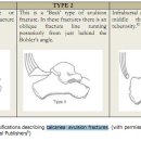 calcaneal avulsion fracture test -＞ Hoffa's test 이미지