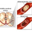 뇌졸중 전조증상 과 예방법 이미지