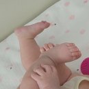 서규영피부과의원 | 👶선천성이소성몽고반점, 결국 김천 서규영피부과에서 레이저 시작했어요 (여아 치료 후기)