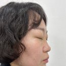 멍이살롱 | 코필러 효과 궁금하신 분들께! 명동 올클리닉에서 받은 자연라인 후기