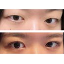 의정부 성형외과 쌍꺼플 수술 눈매교정 후기 쌍수 붓기 멍 실밥제거 한달 차 기록