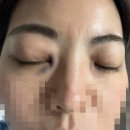 눈물샘막힘 눈물길폐쇄 실리콘관 삽입술 후기