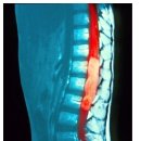 척추암. 척수종양 # 허리디스크? 척추암 증상 이미지