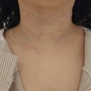 진 | 대구 편평사마귀 성지 편사 없애고 완전히 깨끗해진 후기