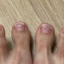 반지세탁소 | 부딪혀서 재발한 내성발톱 재교정 후기 (with 시간과 비용 절감 꿀팁)