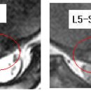 랄라라 님의 요추디스크 L5-S1의 MRI 사진 판독입니다. 이미지