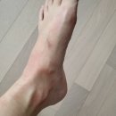 현명기피부과의원 | 코로나19 백신 접종 후기 - 부작용 이상반응 두드러기 및 손저림 현상 / 현명기피부과의원 방문