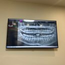 박동수치과의원 | 평택 서울클래식치과 매복사랑니 발치 솔직후기 (주의사항, 통증 등)