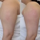 포,제이 | 강남 포제이뷰티 토스카니 메조젯건 후기 스킨부스터 &amp; 팔뚝 지방분해 관리 솔직 리뷰