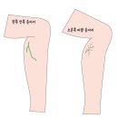 삼성고운맥외과의원 | [혈관경화요법]벼르던 병원 방문! 하지정맥 검사후기