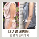 대구 팔 지방흡입 후 관리의 중요성, 한달차 팔라인 변화 솔직 상세후기:)