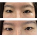 동경양주회천지점 | 의정부 양주 피부관리 비비드엘 1회 관리 전후 차이 후기 기미 잡티 개선 효과