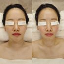 오늘도소중한 | 압구정 웨딩촬영전 관리 비대칭 얼굴관리 스파유 압구정 비포애프터 후기