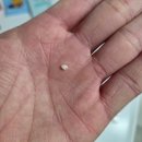 아주탑치과의원 | 제일 끝 어금니 모서리 파절, 깨짐 치료 후기 Feat_ 안양 우리 좋은 치과 의원